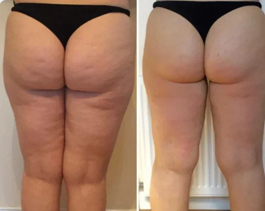JOYO Anti-Cellulite Avis : Test 7 jours, résultats & conseils