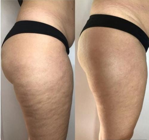 Silkgirl avis : mon analyse honnête des huiles (anti-cellulite & vergetures) et ce qu’on peut vraiment attendre